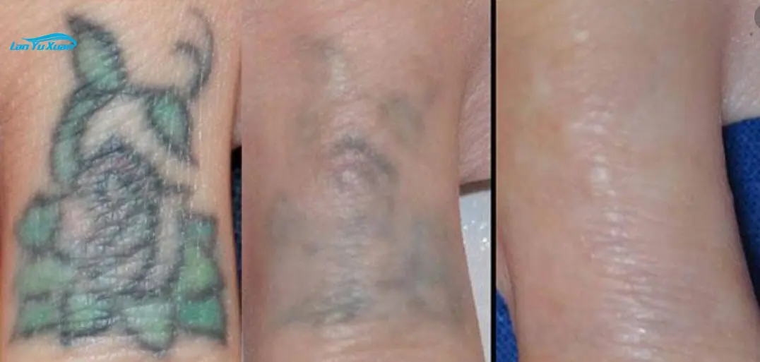 Jauno tetovējumu noņemšanas 1064nm profesionālās garo impulsu lāzeru Q switch un YAG tetovējumu noņemšana ar lāzeru pigmenta noņemšana mašīna